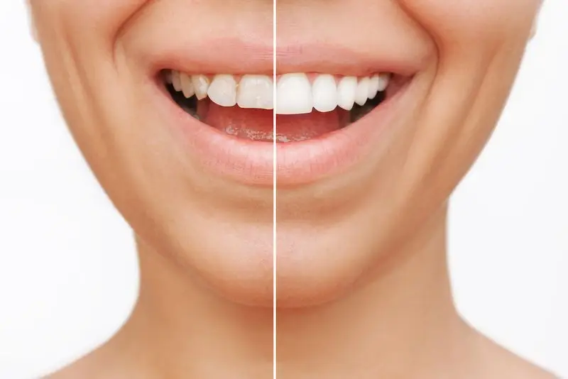 Dentist-In-Portland-OR-Are-Veneers-Permanent