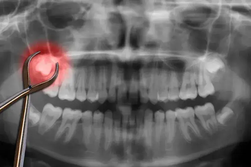 Dentist-In-Portland-OR-Can-I-Go-to-Work-the-Next-Day-After-Wisdom-To_x7miAUk