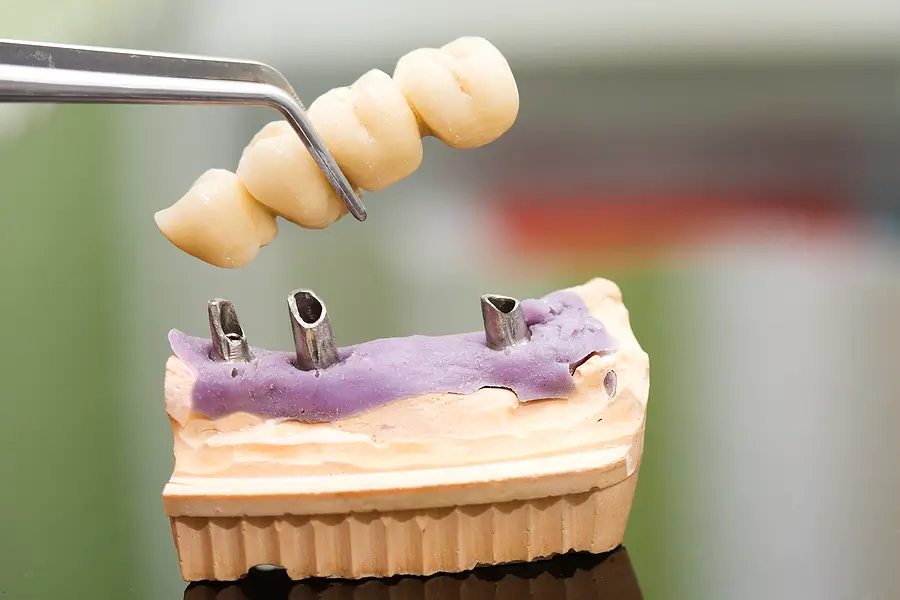dental-bridges-in-portland-or_Tm0g5jk