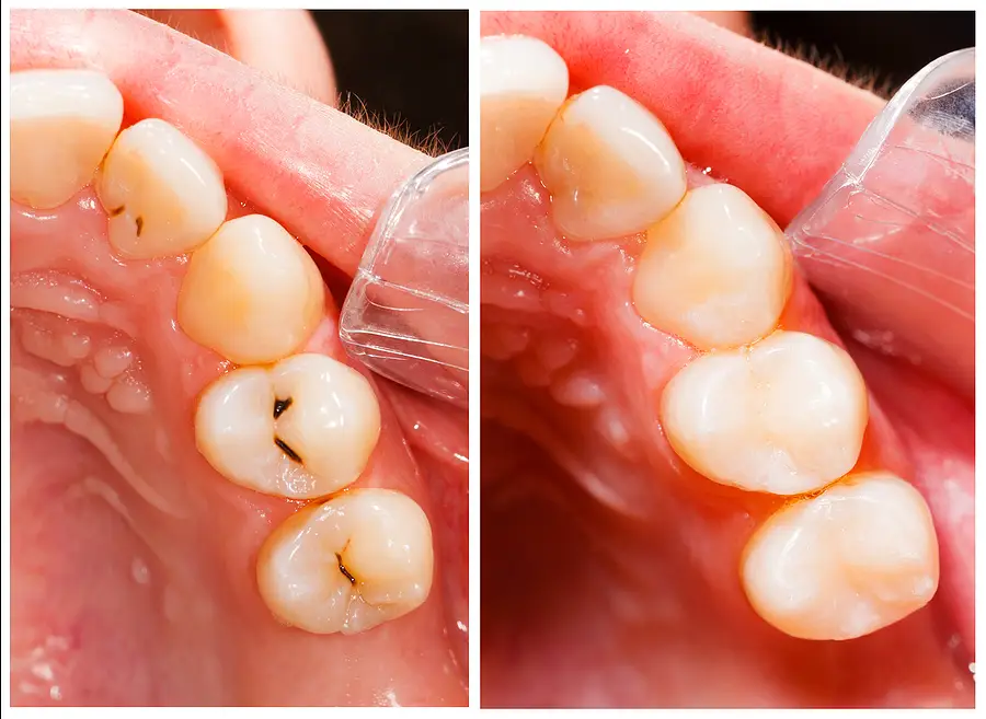 dental-fillings-in-portland-or_25ow43W