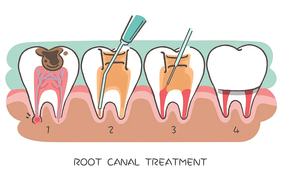 root-canal-treatment-in-portland-or_4pH0Wub