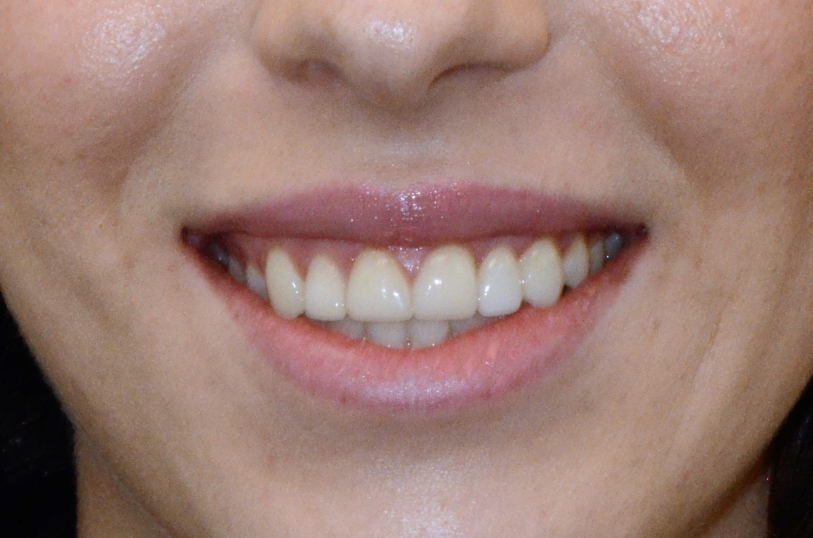 Pt1 After - veneers, bridge and Invisalign