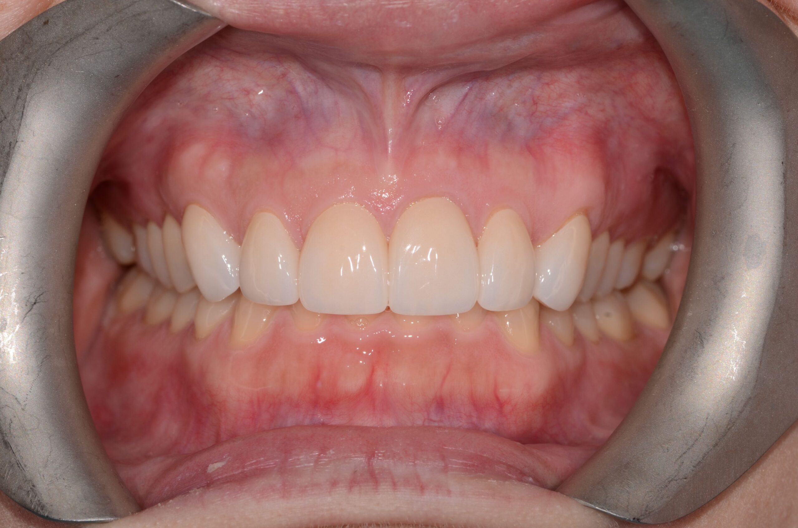 Pt3 After - anterior veneers