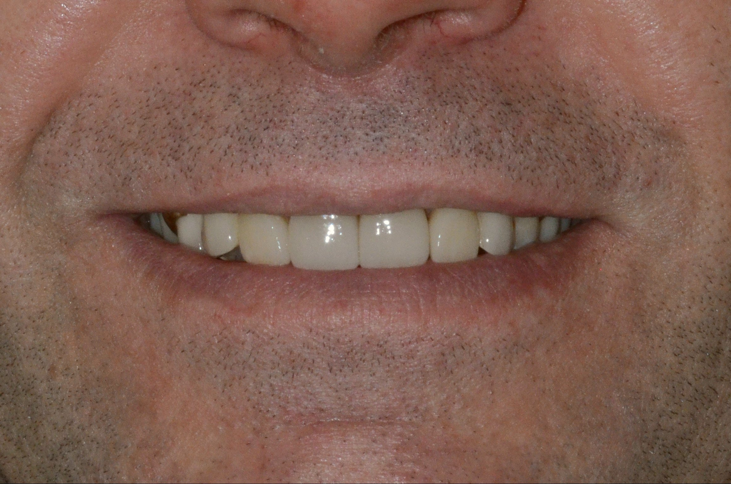 Pt4 After - anterior crowns (1)