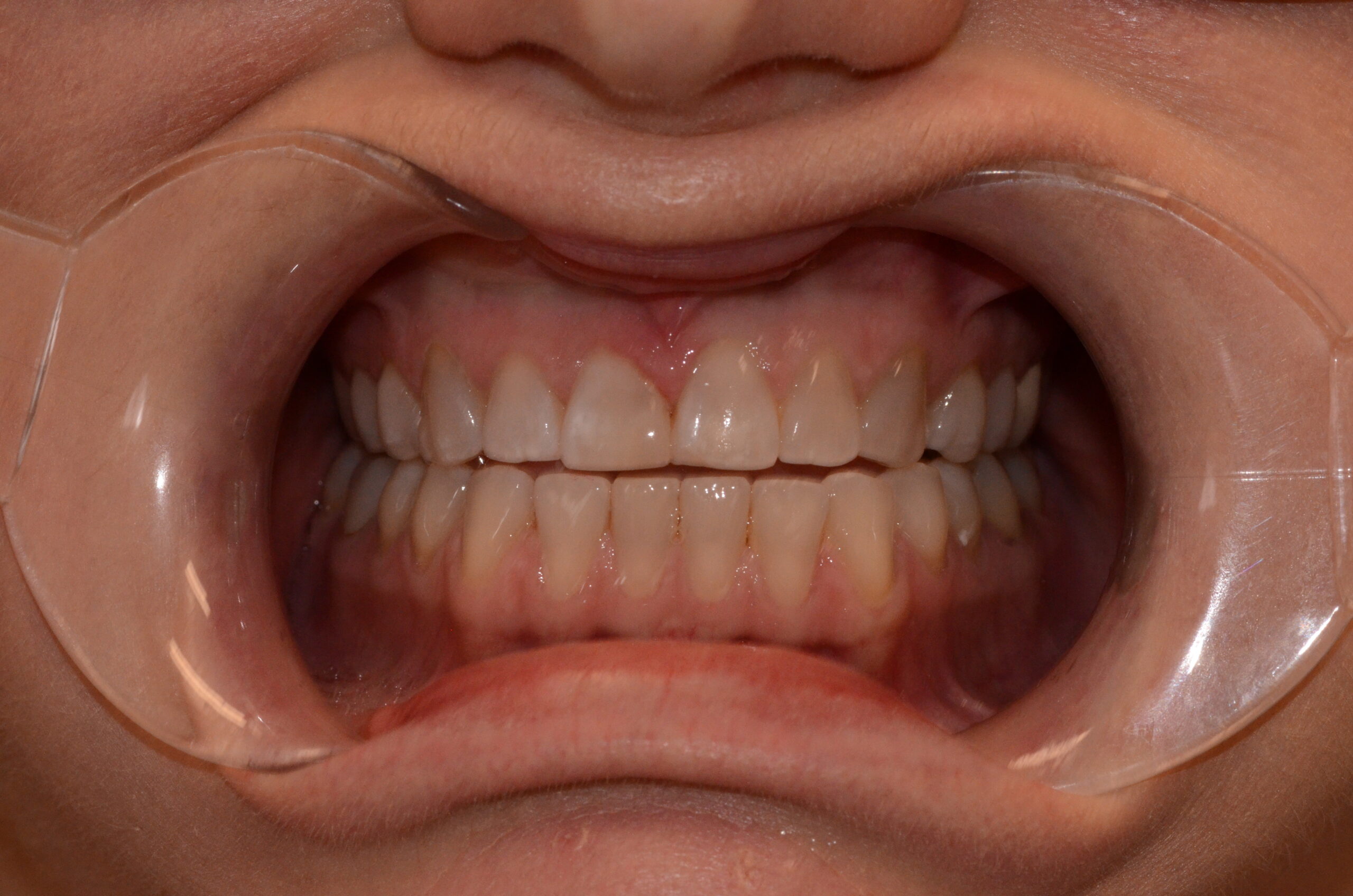 Pt5 After - composite repair