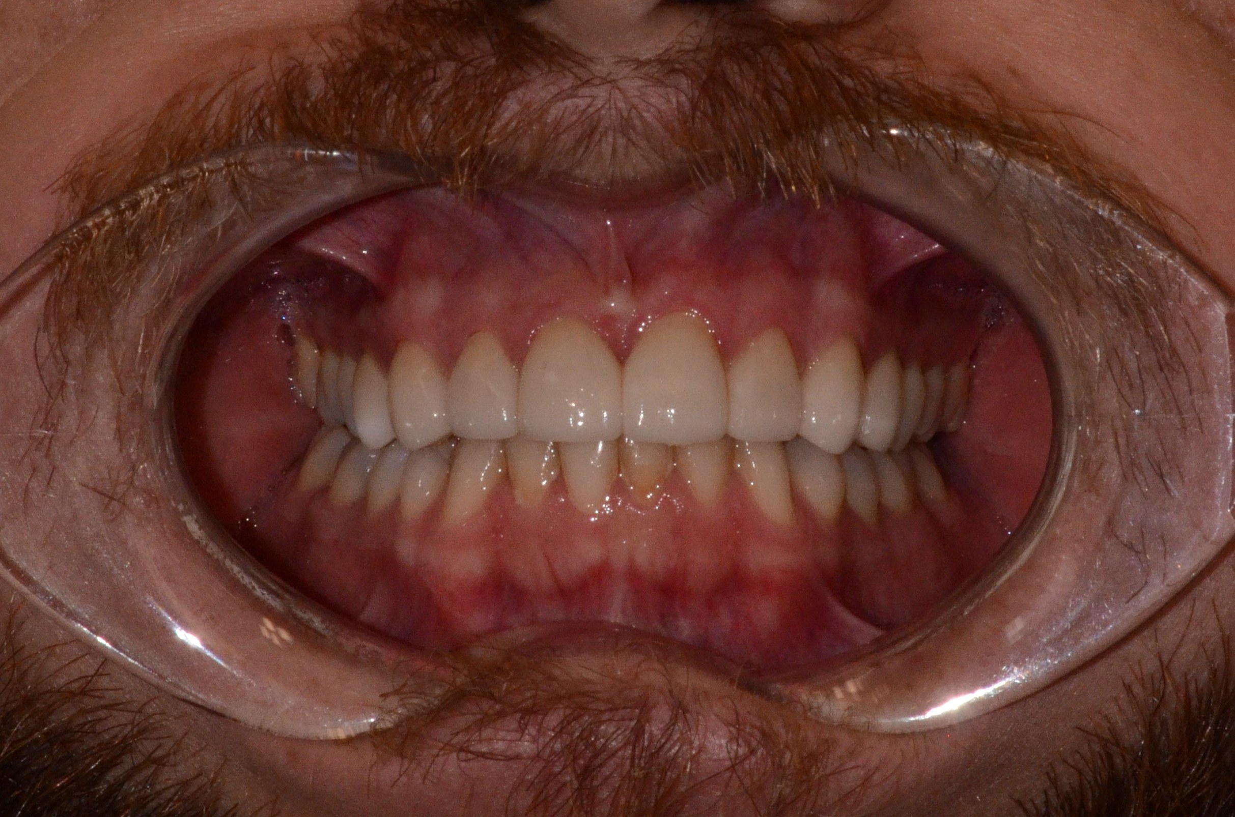 Pt6 After - anterior crowns and veneers