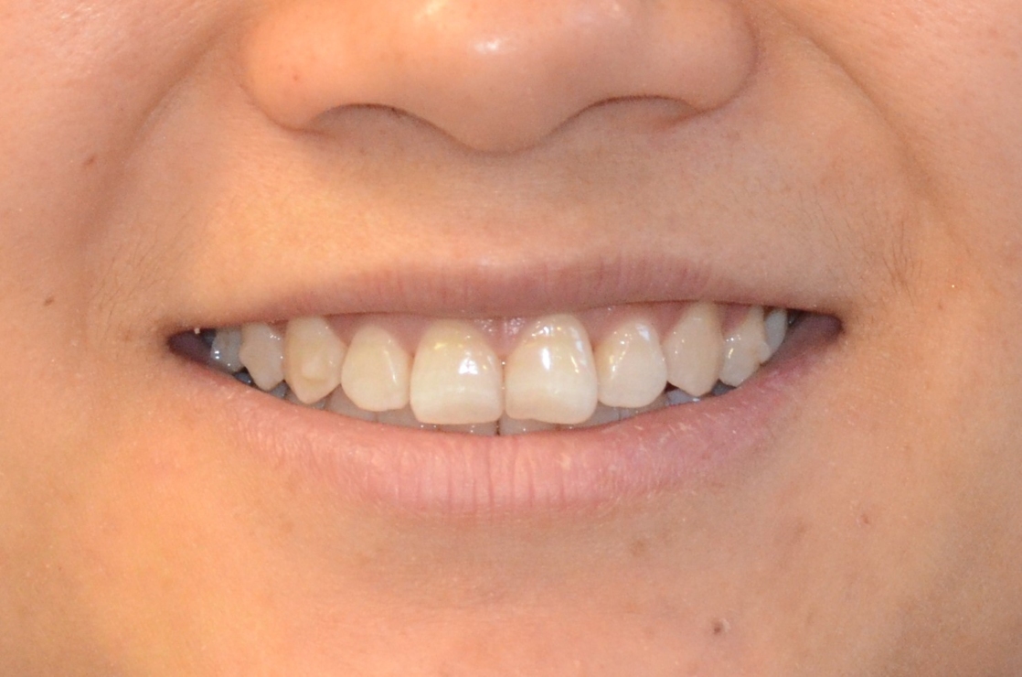 Pt7 After - Invisalign