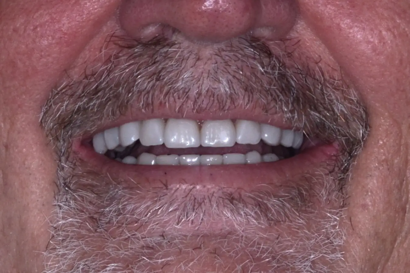 Pt8 After - Crowns